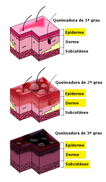 Graus de queimadura