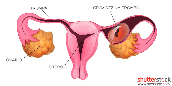 Gravidez ectópica - Gravidez tubária