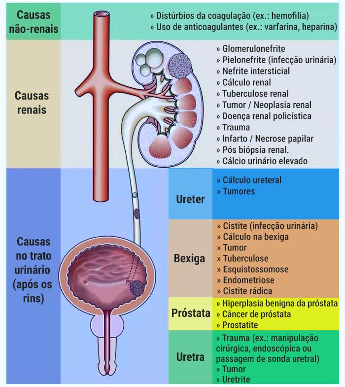 Infográfico listando as principais causas de sangue na urina.