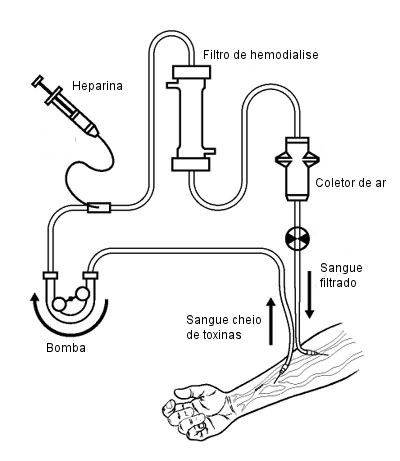 Como funciona a hemodiálise