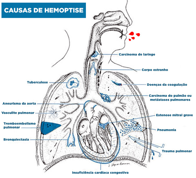 Principais causas de hemoptise