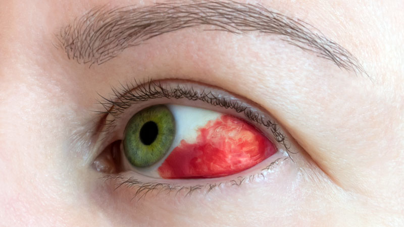 hemorragia subconjuntival