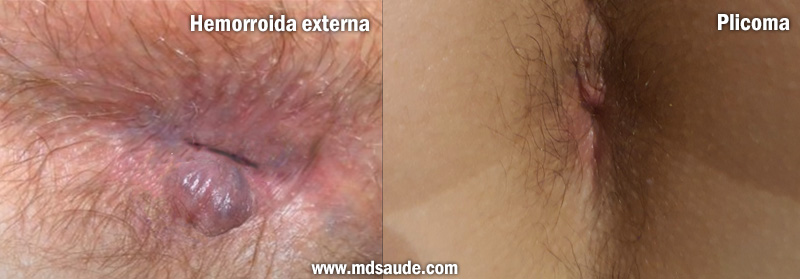 Diferenças entre plicoma e hemorroida