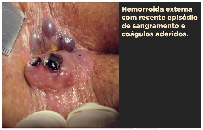 Hemorroida externa com sinais de trombose e coágulos de sangramento recente