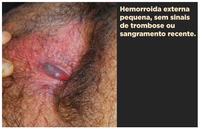 Hemorroida externa