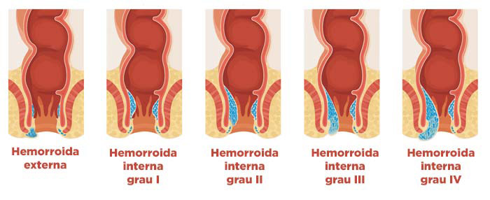 Graus da doença hemorroidária