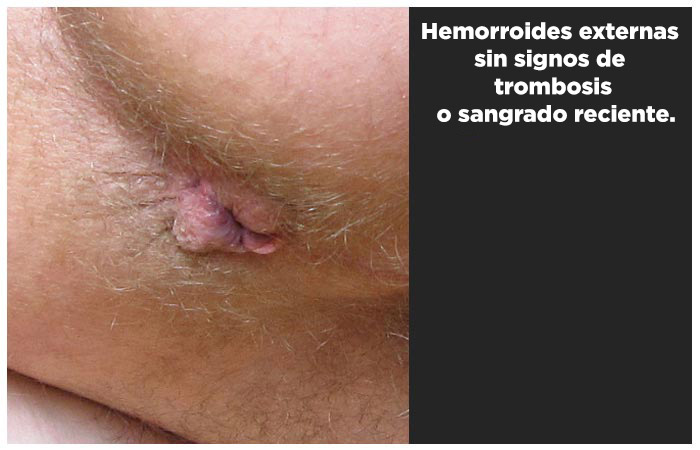 Hemorroides externa