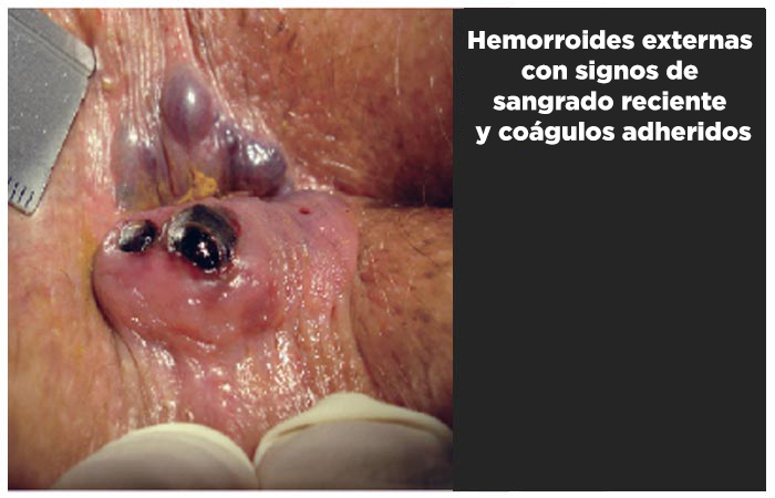 Hemorroides externas con trombosis, signos de sangrado reciente y coágulos adheridos