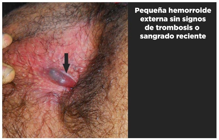 Pequeña hemorroide externa sin signos de trombosis o sangrado reciente