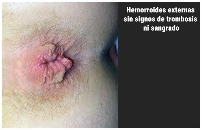 Hemorroides externa sin signos de trombosis ni sangrado