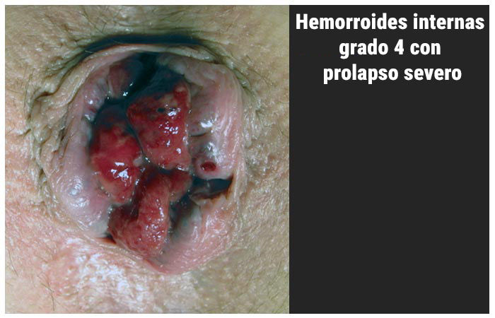 Hemorroides internas grado IV con prolapso severo y congestión vascular.