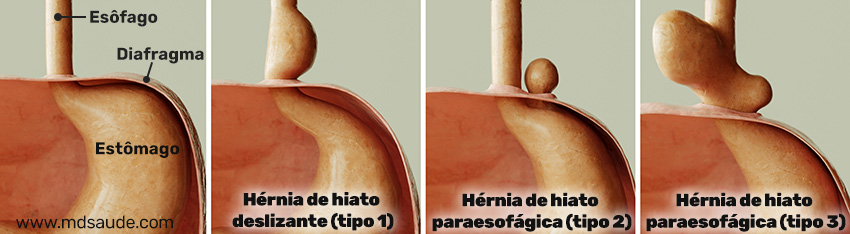 Tipos de hérnia de hiato