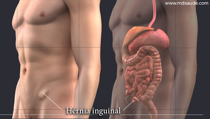 Hérnia inguinal