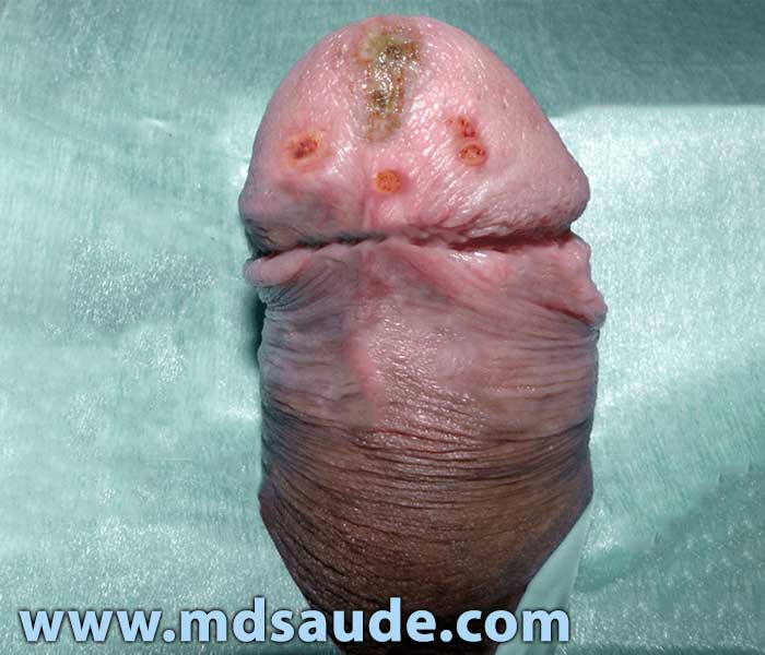 Herpes genital