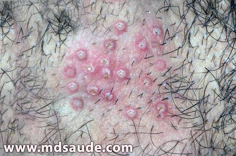 Vesículas do herpes genital