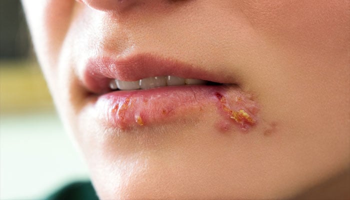 Herpes labial