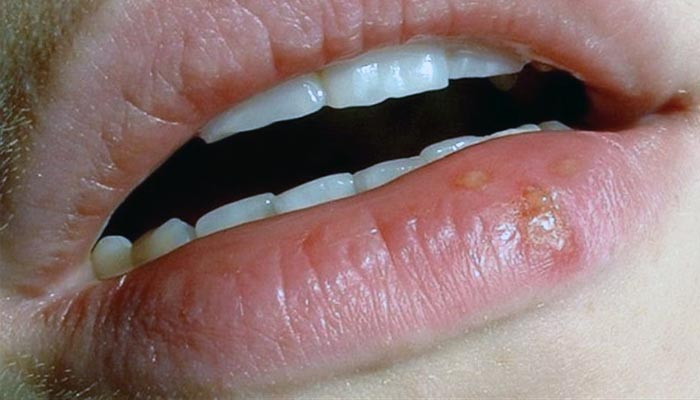 Herpes labial