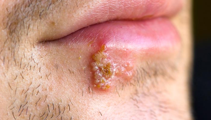 Herpes labial