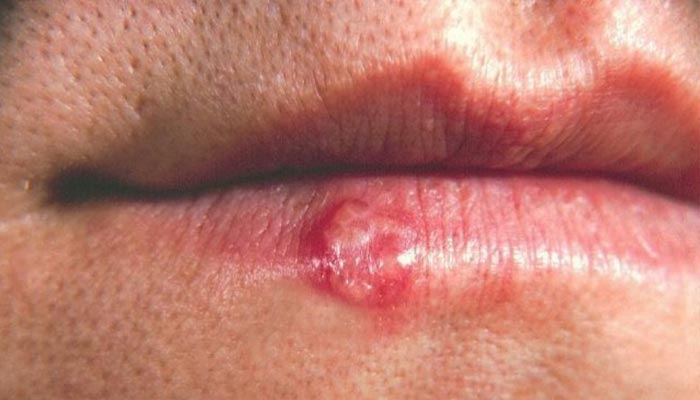 herpes labial