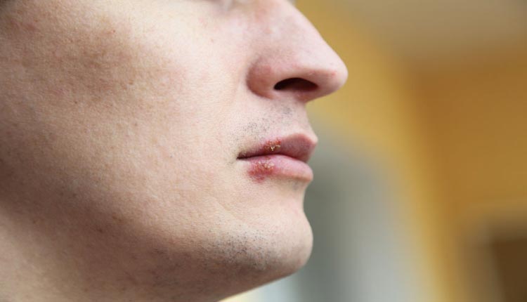 Herpes labial