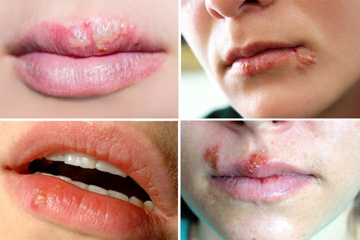 Herpes labial: ampollas y costras rojizas y amarillentas