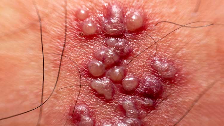 Herpes