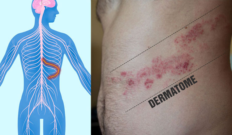 Dermatome - herpes zoster