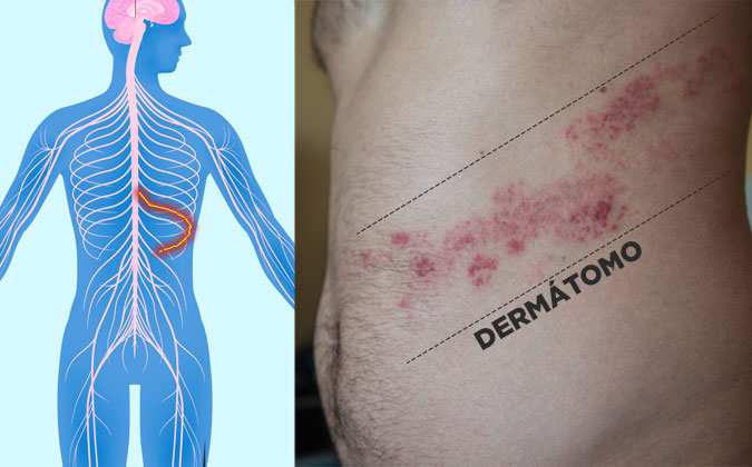 Dermátomo - herpes zoster