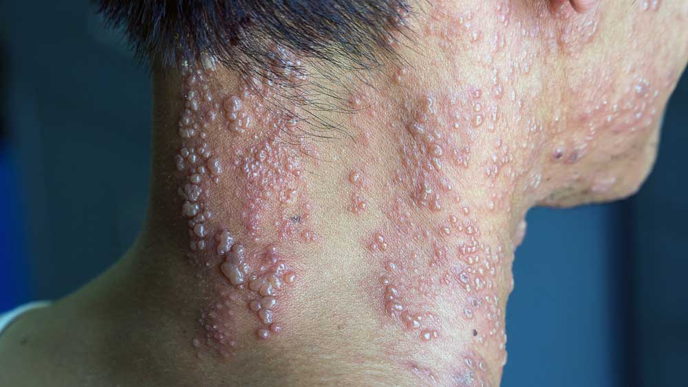 Shingles