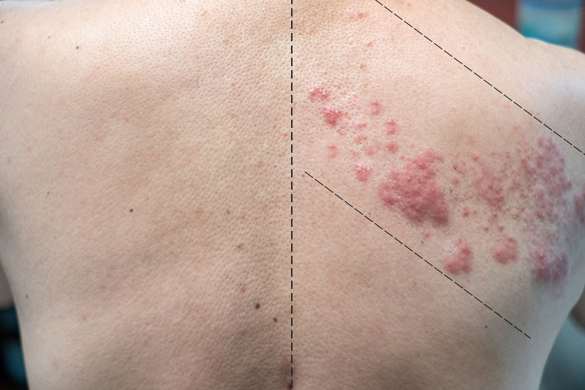 Herpes Zoster