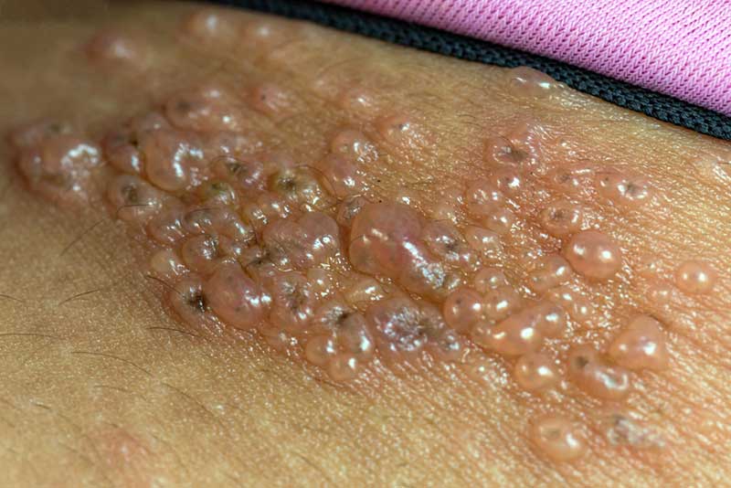 Clusters of vesicles (blisters) typical of herpes zoster