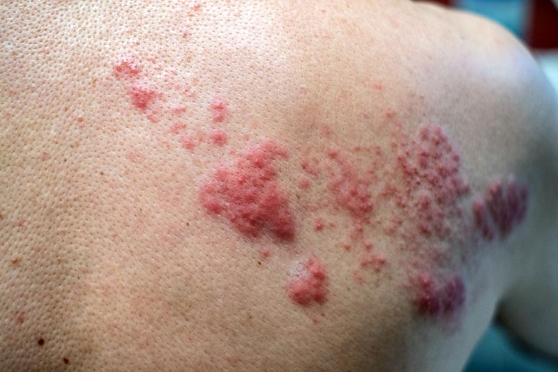 Shingles lesion on the back.