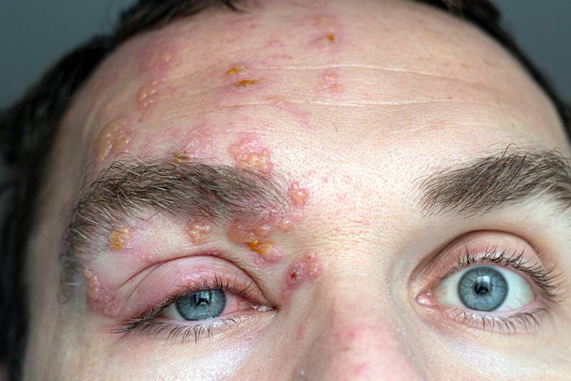 Facial shingles