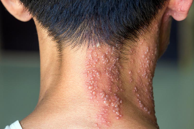 Shingles affecting the right side of the neck