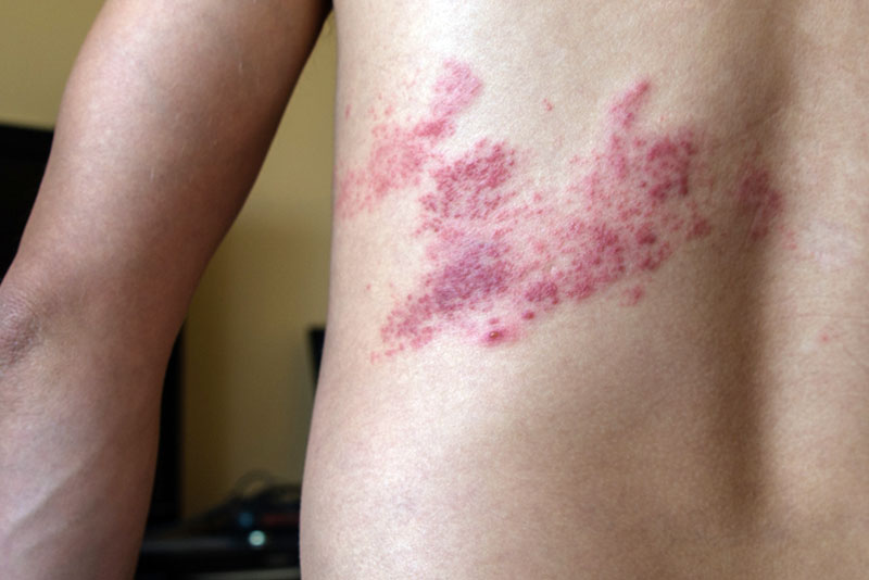 Shingles on the back “in a band”