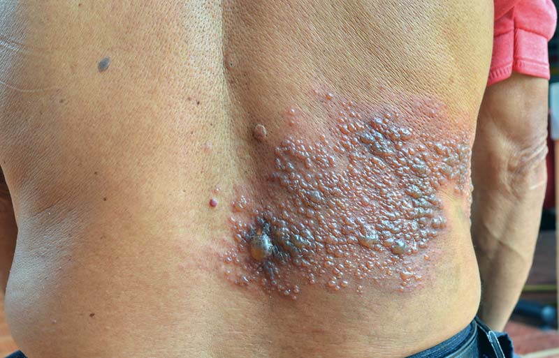 Shingles on the right side of the back