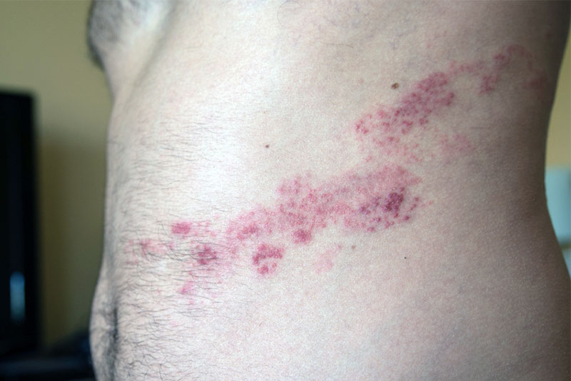 Strip-like herpes zoster lesion on the left flank