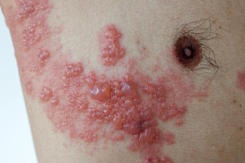 Shingles affecting the right chest and armpit area