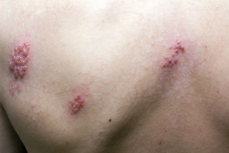 Sparse herpes zoster lesions