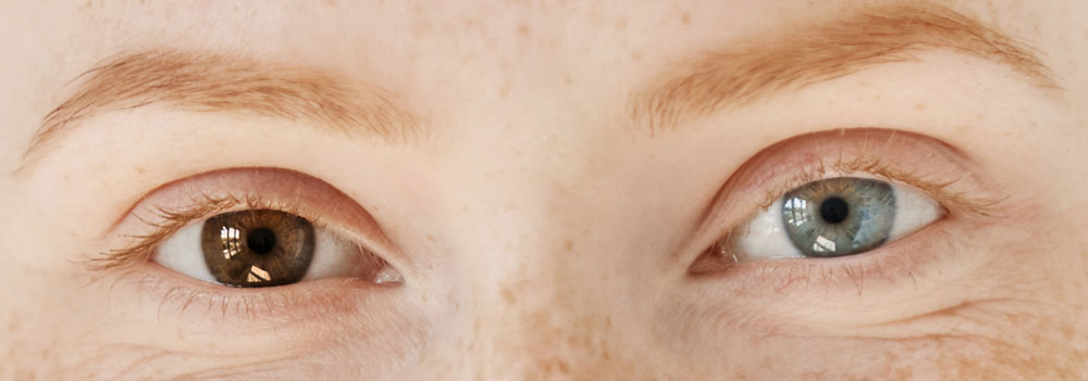 heterocromia - um olho de cada cor