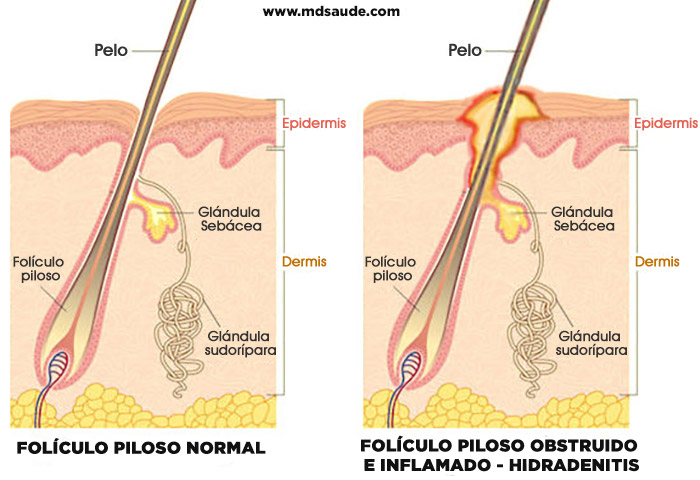 Hidradenitis supurativa