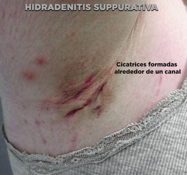 Hidradenitis supurativa - etapa 2