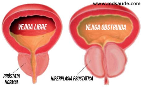Obstrucción urinaria por hiperplasia prostática