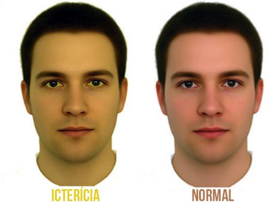 Icterícia