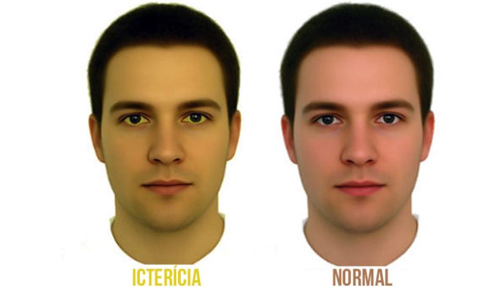 Comparação entre pele ictérica e pele normal