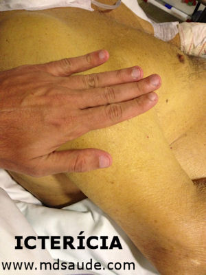 Ictericia - piel amarillenta