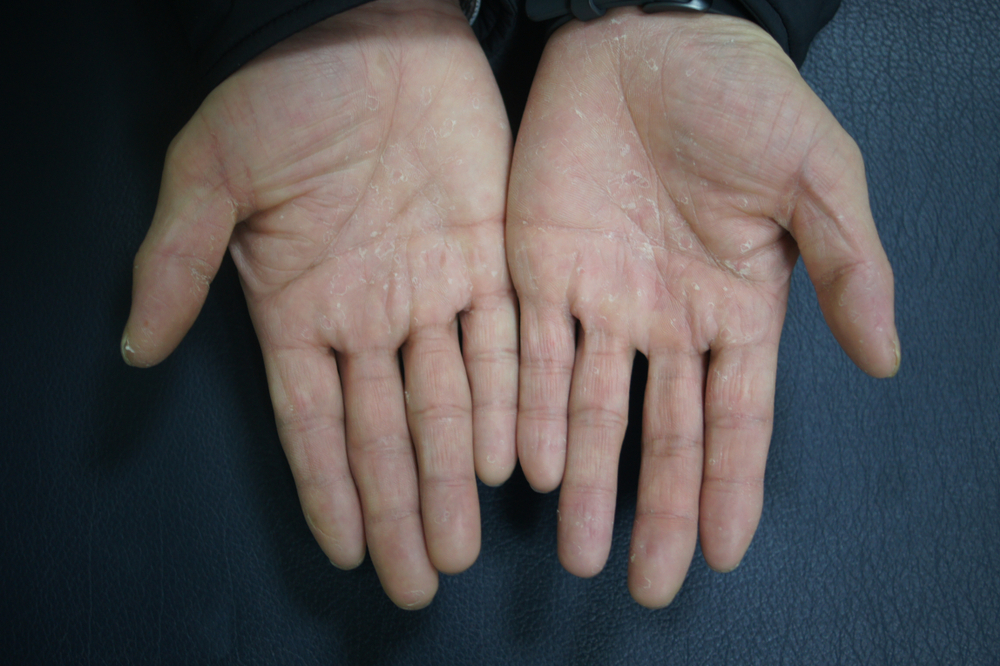 Scaling of the hands in dyshidrosis