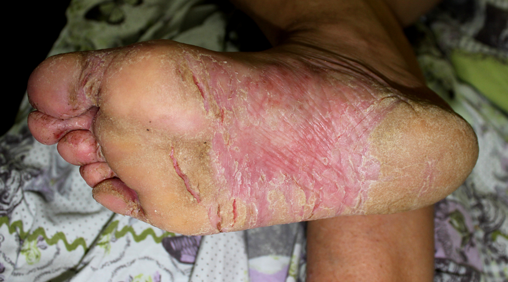 Chronic Dermatitis of the Feet due to Dyshidrosis
