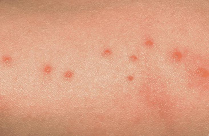 Bed bug bites in a line and with small dark spots in the center