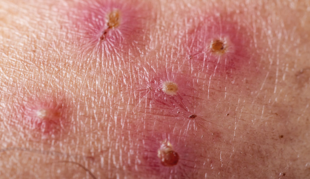 Lesões do impetigo